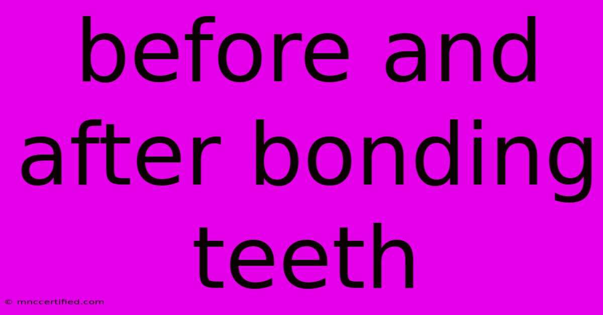 Before And After Bonding Teeth