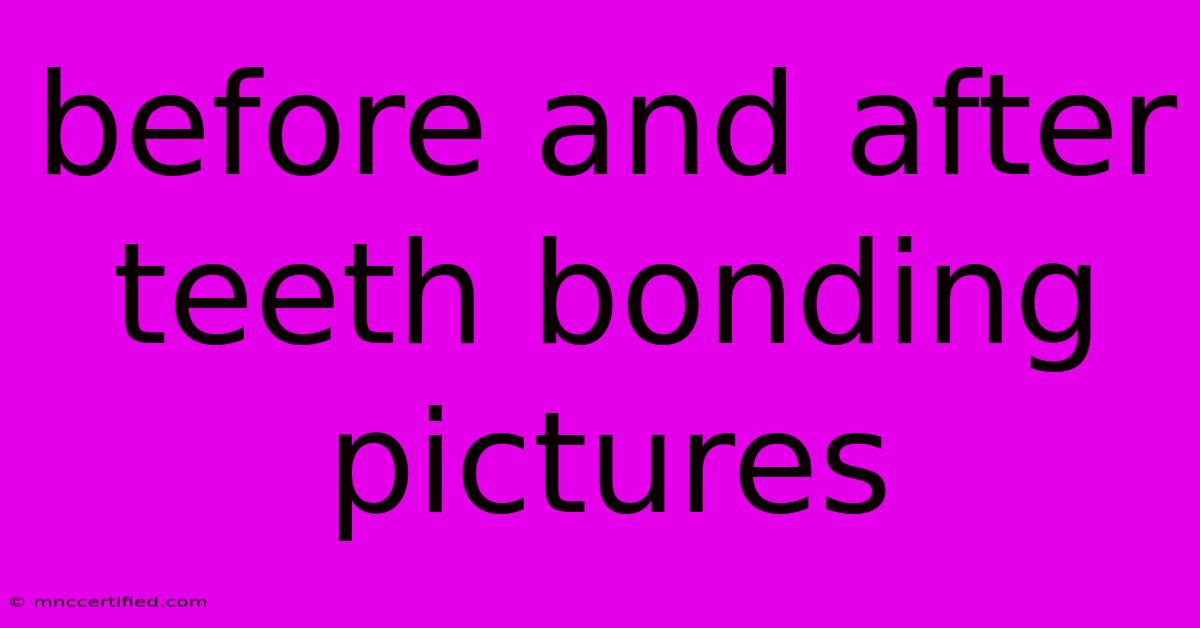 Before And After Teeth Bonding Pictures