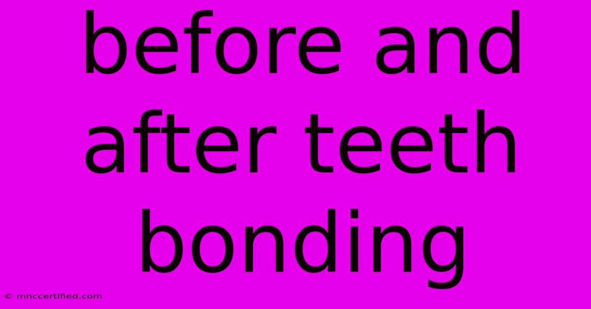 Before And After Teeth Bonding