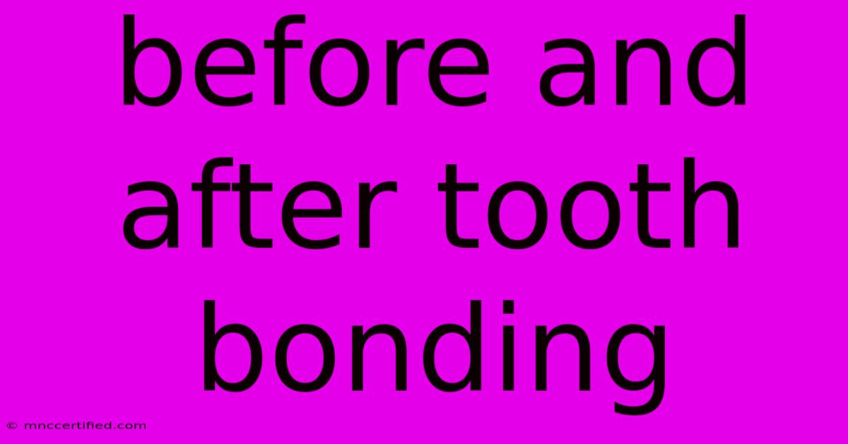 Before And After Tooth Bonding