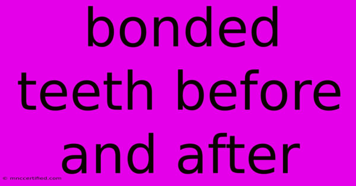 Bonded Teeth Before And After