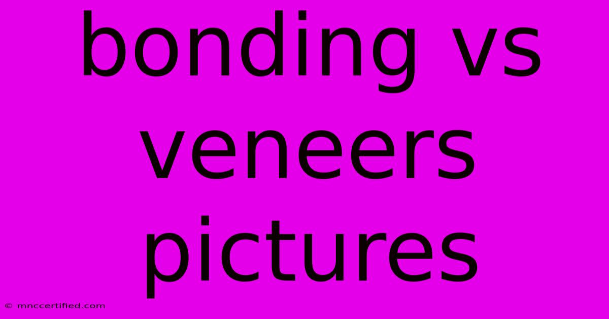 Bonding Vs Veneers Pictures