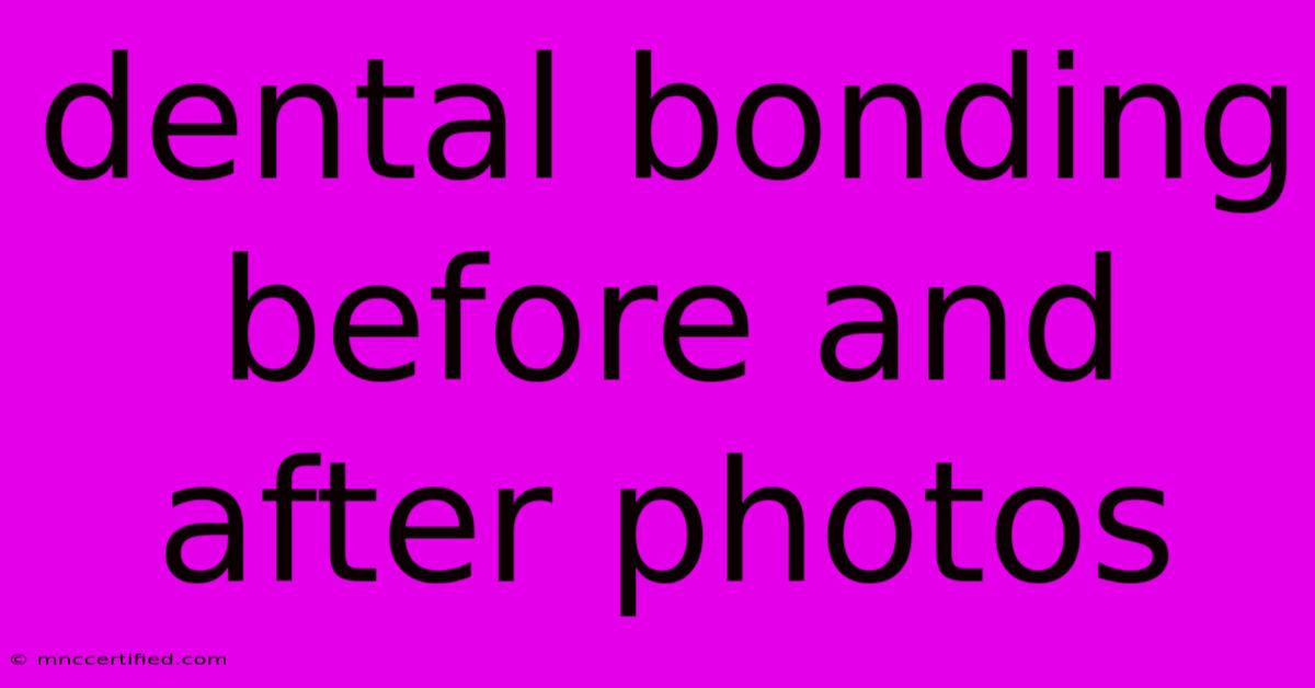 Dental Bonding Before And After Photos