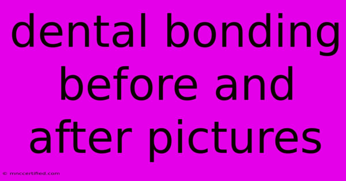 Dental Bonding Before And After Pictures