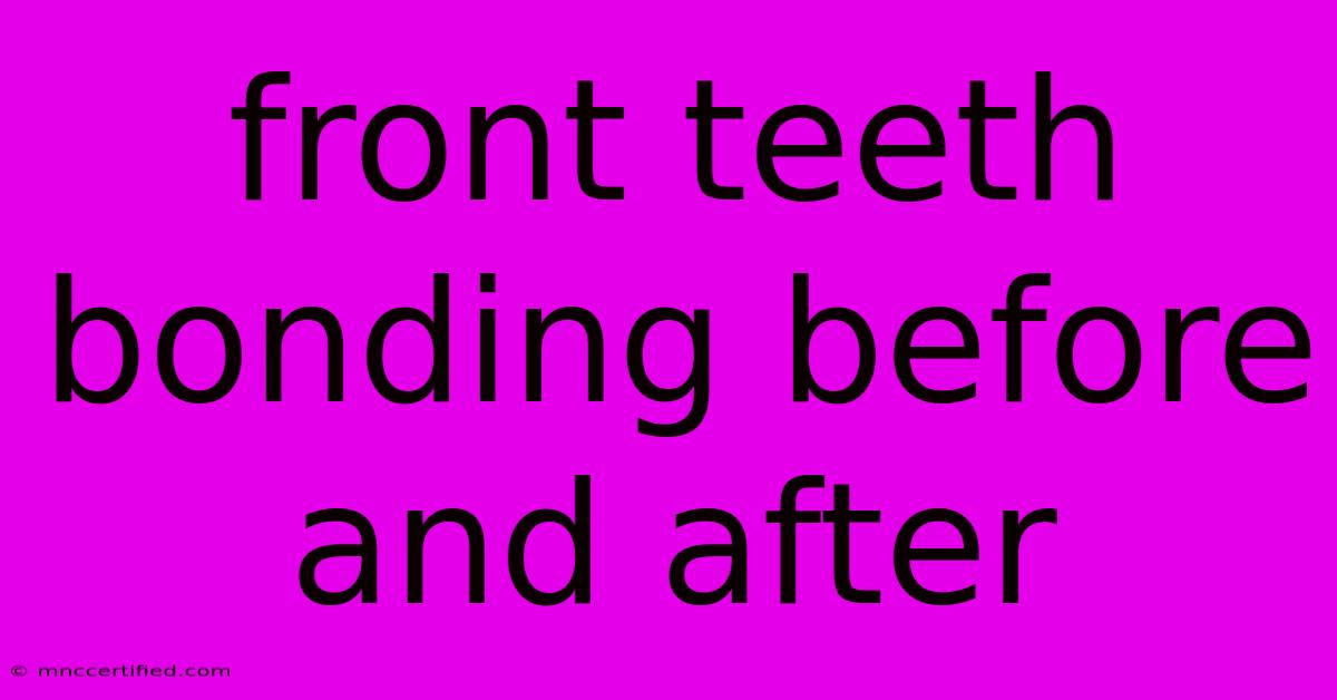 Front Teeth Bonding Before And After