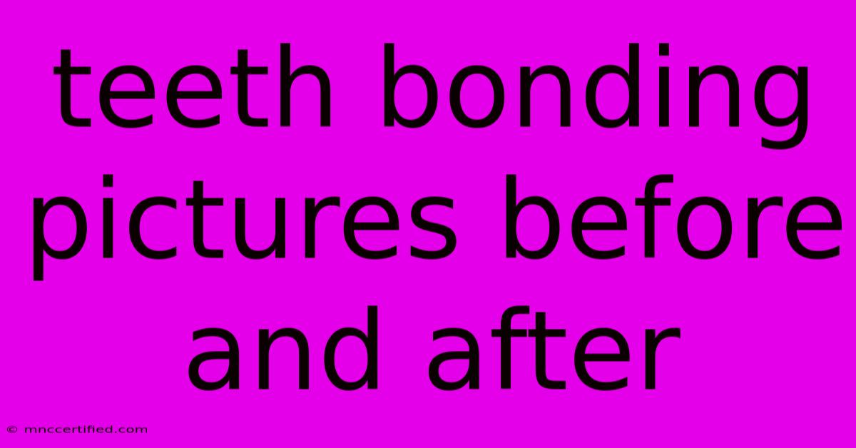 Teeth Bonding Pictures Before And After