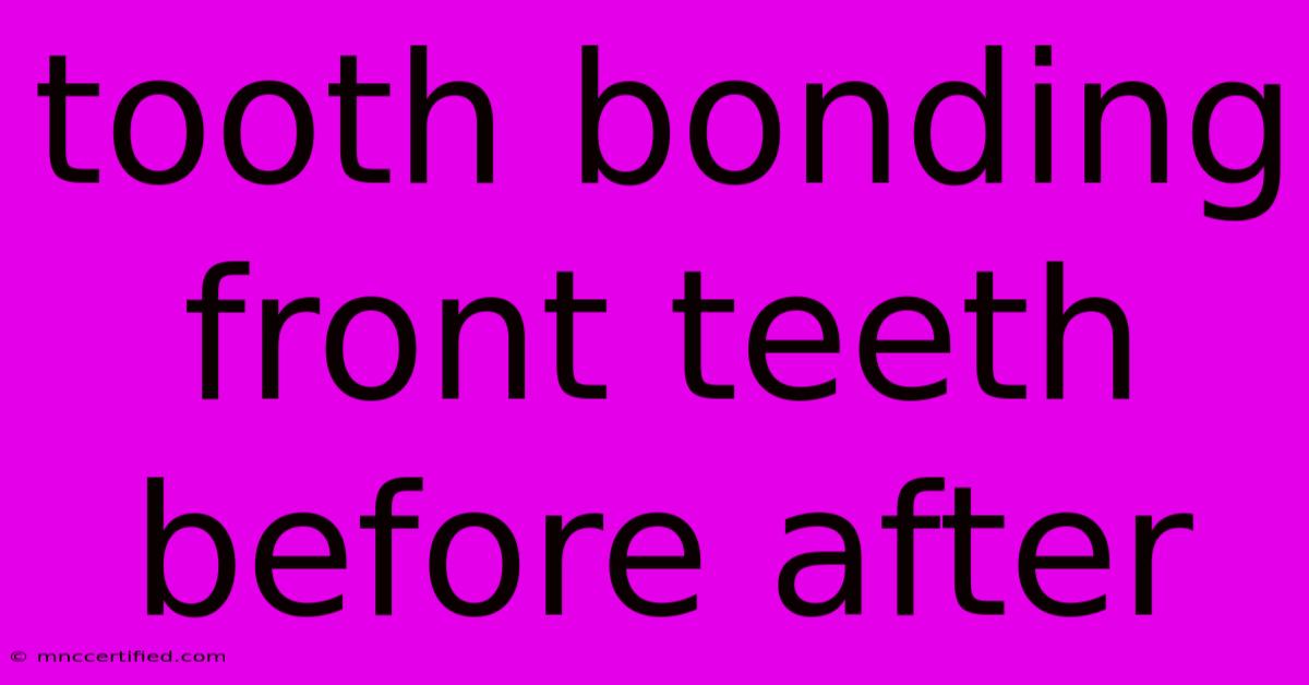 Tooth Bonding Front Teeth Before After